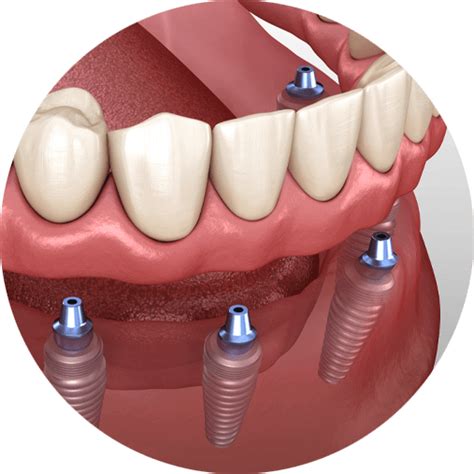 dental implants yuba city|Full Mouth Dental Implants .